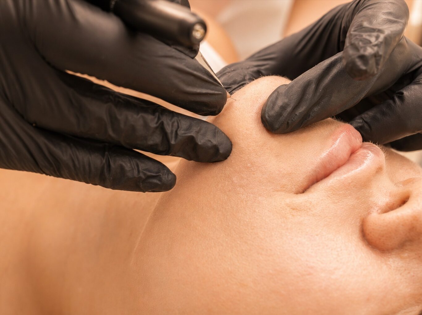 infinity esthetique salon institut de beauté paris 13 épilation définitive Électrolyse hormonales visage